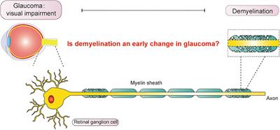 Demyelination of the Optic Nerve: An Underlying Factor in Glaucoma?